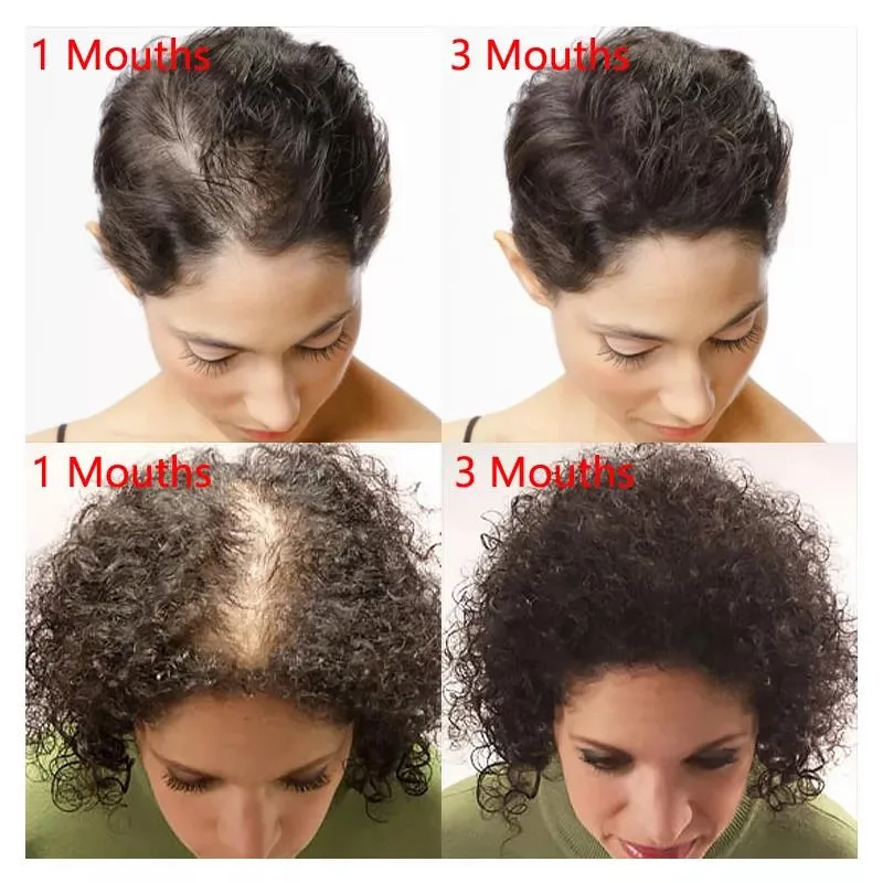 Minoxidil Promotes Hair Growth Build Your Own Label Nourishing Thick Care Hair Growth Private Label Kirkland Hair Oil