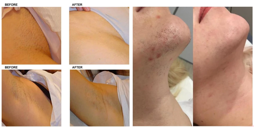 Diode IPL ND YAG Laser Hair Removal Skin Rejuvenation