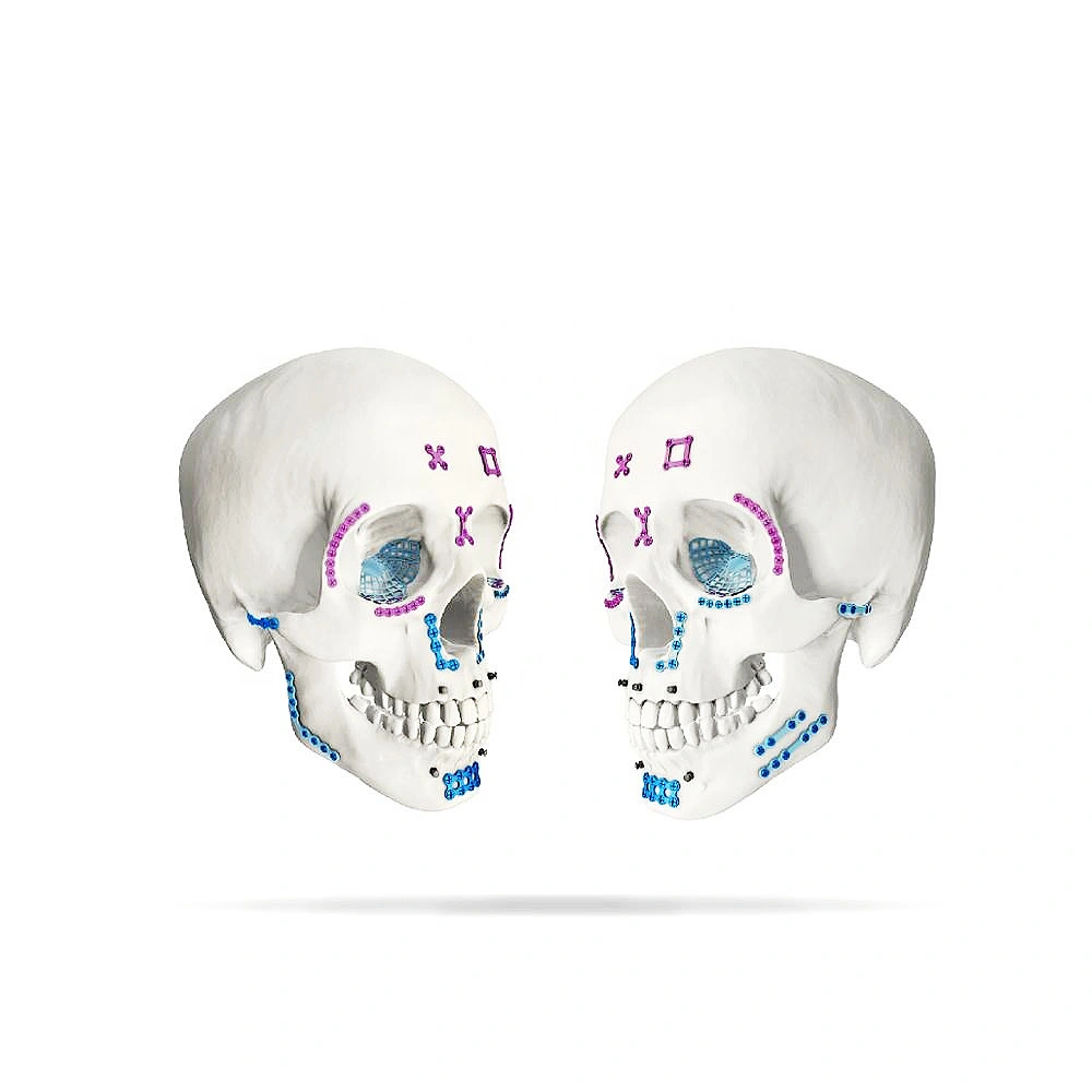 Maxillofacial Straight Bsso (Bilateral Sagittal Split Osteotomy) Plate 4 Holes 1.0mm Thickness