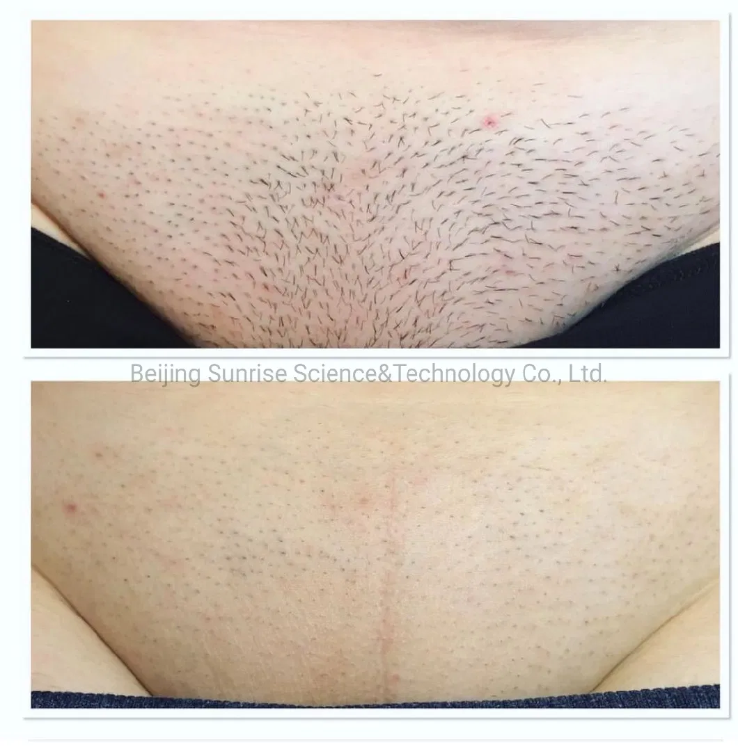 Laser Hair Removal with 755 808 1064nm Diode Laser