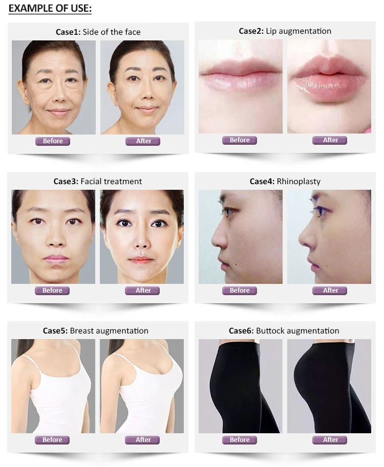 Hyaluronic Acid Filler Nasolabial Folds Authentication Injectable Gel