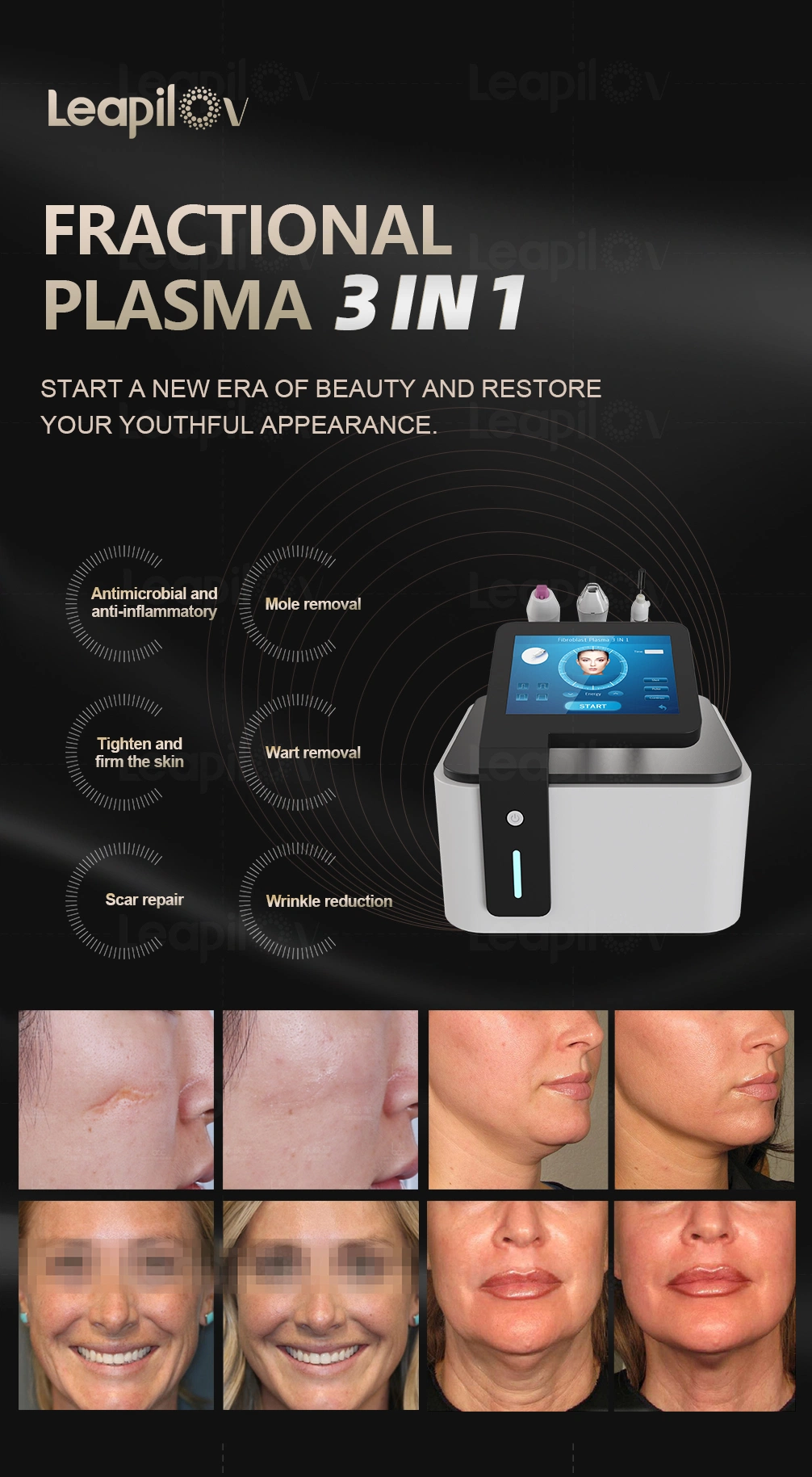 Facial Treatment 3in1 Plasma Machine for Skin Peeling Machine