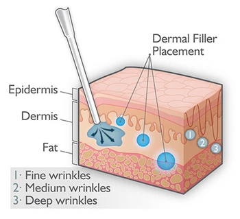 Hyaluronic Acid Filler Nasolabial Folds Authentication Injectable Gel