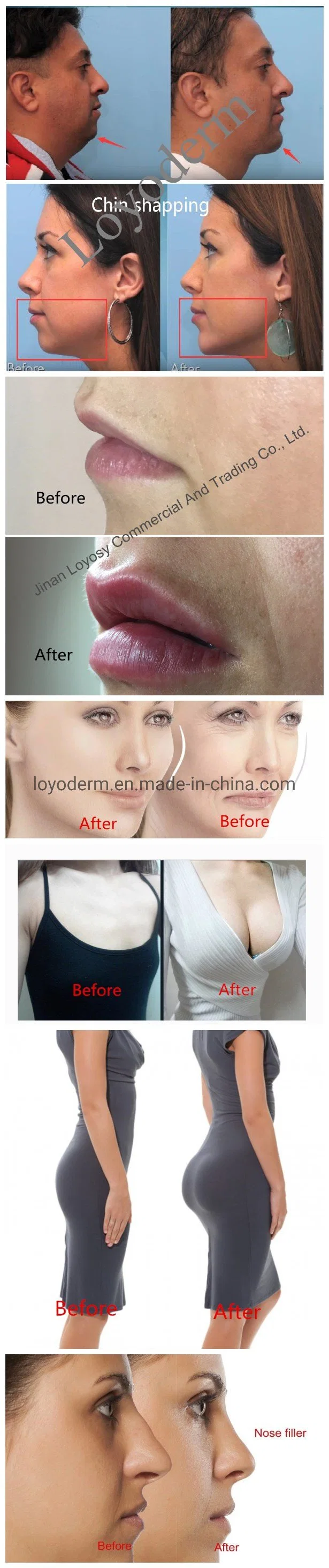 Nasolabial Folds Authentication Safe Injectable Sodium Hyaluronate Gel Dermal Filler