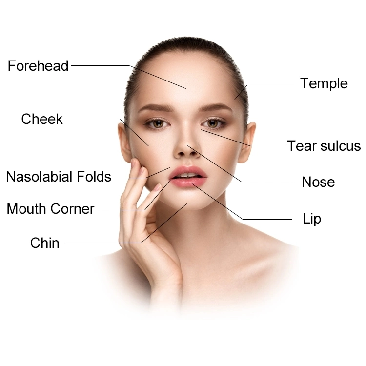 Nasolabial Folds Authentication Safe Inhectable Sodium Hyaluronate Gel Hyaluronic Acid Dermal Filler