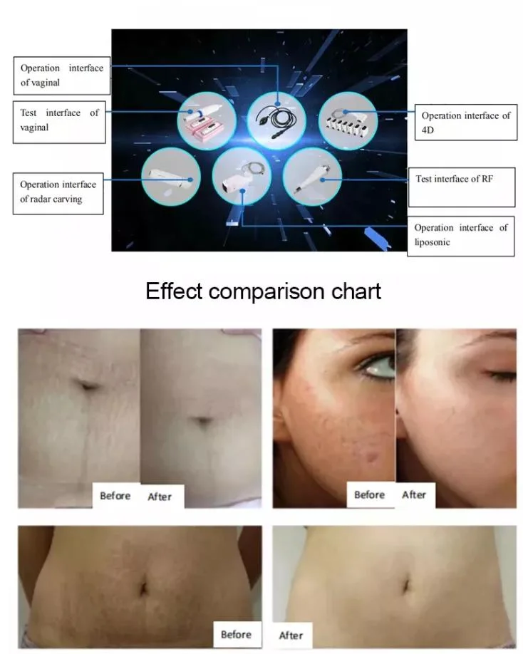 Body Slimming Vaginal Tightness Detection Liposonic 4D 9d Hifu Face Machine Korea
