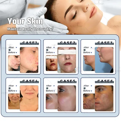 Aqua пилинг Hydra воды кислородом Microdermabrasion Косметический уход за лицом салон красоты оборудование Hydro кожу скруббер Dermabrasion Hydra машины на лице гидроуправления