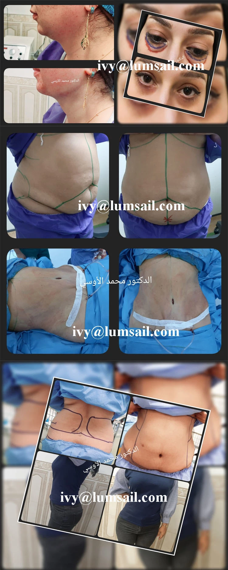 Dual Suction Pump Power Assisted Liposuction with Fat Transfer Liposuction Cannula Needle Set