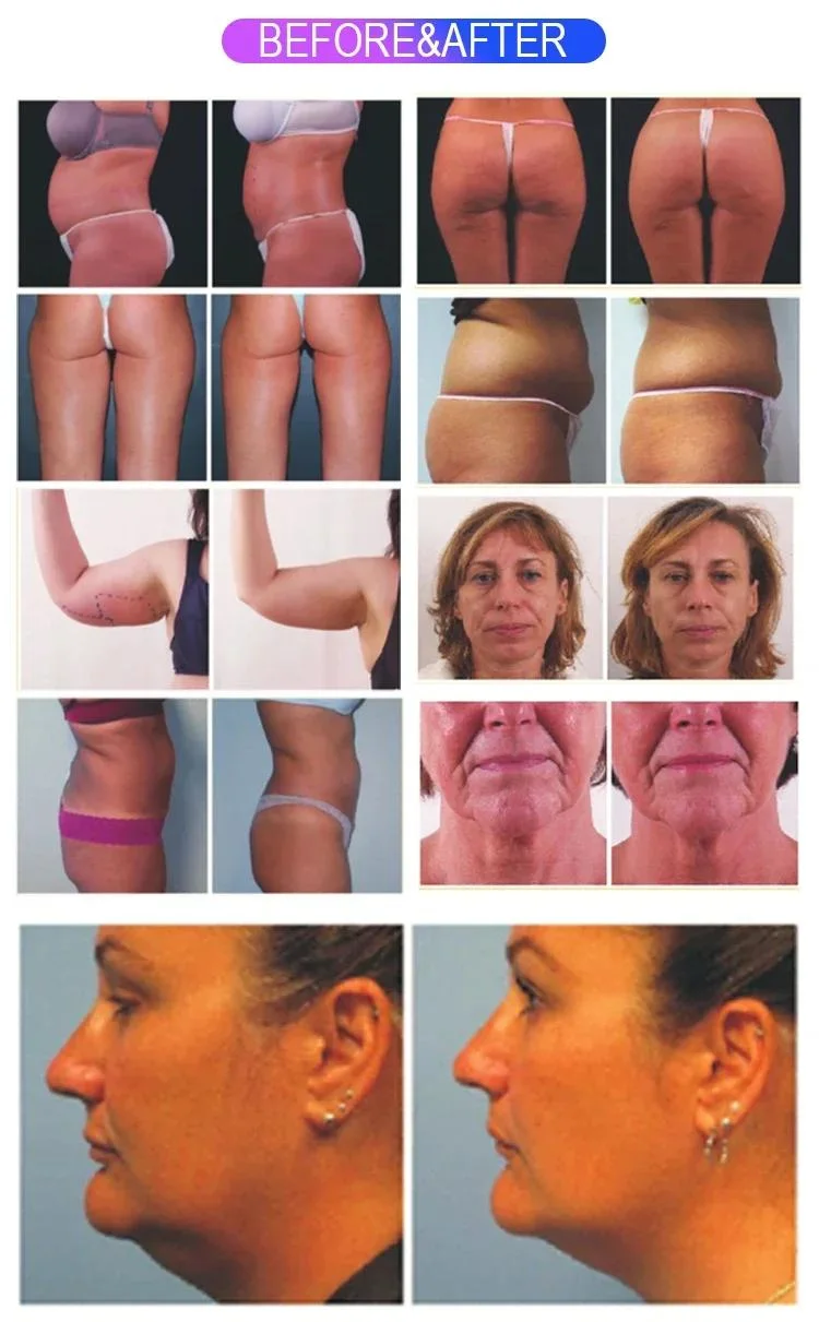 Salon Use Body Shaping RF Skin Tightening Face Lifting Machine RF Anti Wrinkle Machine